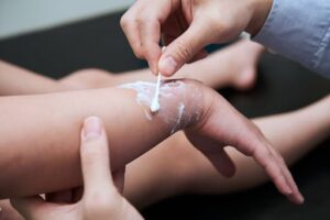 burn injury